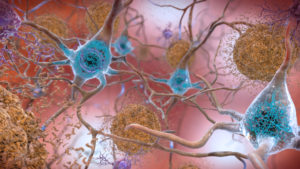This illustration shows the two main forms of disruptive protein clumps found in the brains of people with Alzheimer’s disease: beta-amyloid plaques (seen in brown) that collect between neurons and disrupt cell function, and tau protein tangles (seen in blue) that build up within neurons, harming synaptic activity. (Credit: National Institute on Aging, NIH)