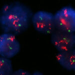 Fluorescence microscopy image of breast cancer cells shows strong HER2 amplification in red.