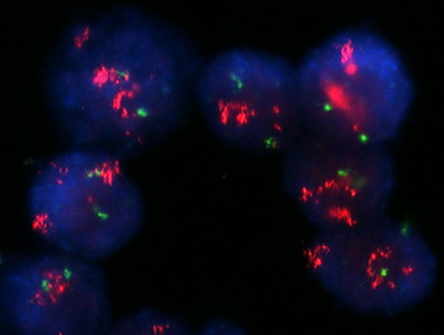 Fluorescence microscopy image of breast cancer cells shows strong HER2 amplification in red.