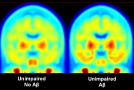 Side by side colorized positron emission tomography images of two brains in coronal cross-section.